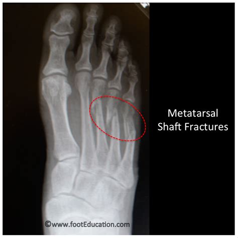 Metatarsal Bone Fracture