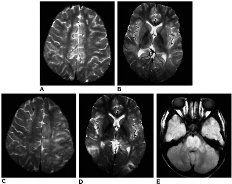 An 8-year-old boy with a 3-month history of SSPE, clinical stage G:IIA ...