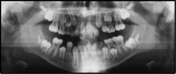 Regional odontodysplasia: Orthodontic treatment and transplantation of premolars | Pocket Dentistry