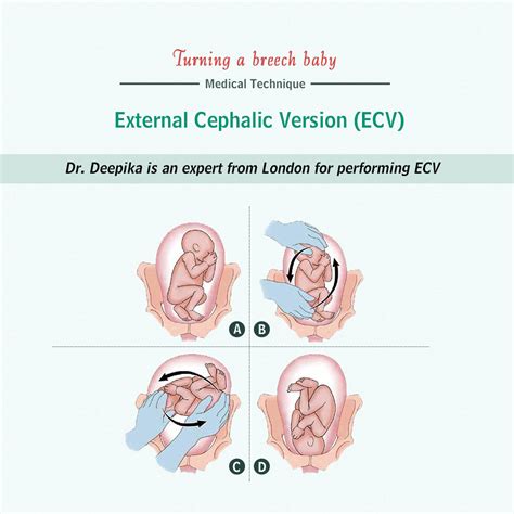 Breech Baby and External Cephalic Version – Dr. Deepika Aggarwal – a Consultant Obstetrician and ...