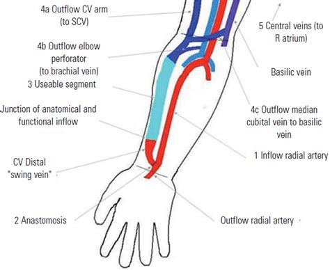 Arterial Venous Fistula For Hemodialysis Proximal Radiocephalic Fistula – NBKomputer