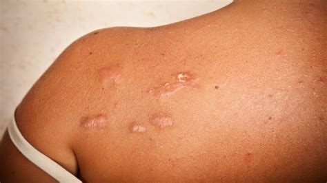 Black Skin Care 101: What Are Keloid Scars and How Do Black Women You Get Rid of Them? - Essence