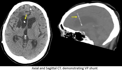 Axial and sagittal CT demonstrating ventriculoperitoneal (VP) shunt ...