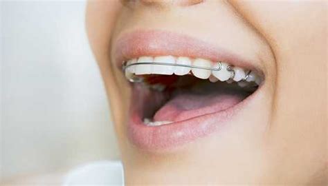 Have a Permanent Orthodontic Retainer? : Cleaning Tips – Sabka Dentist ...