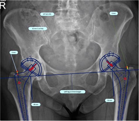 Accuracy of Total Hip Arthroplasty Templating Using Set Calibration Magnifications | Cureus