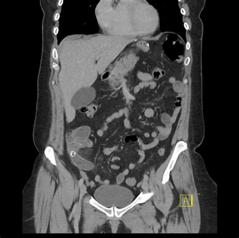 Appendicitis Ct Radiopaedia It is a very common condition in general radiology practice and is ...