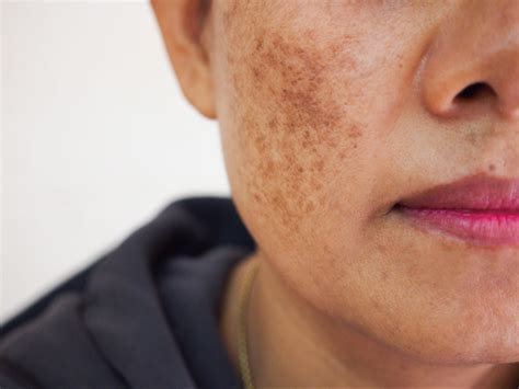 Pigmentation visage : melasma / lentigo / éphélides - Plasma Clinic