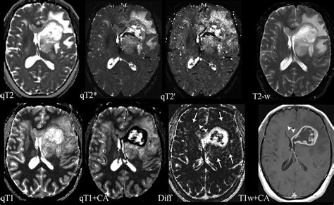 MR Methods in Differential Diagnosis of Brain Tumors | Radiology Key