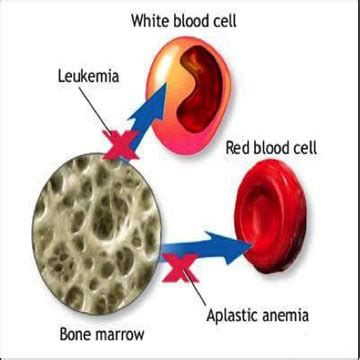 How to Treat Aplastic Anemia in Ayurveda