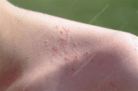 Prickly heat blisters - Stock Image - C009/8377 - Science Photo Library