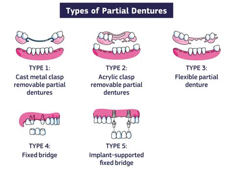 Partial Dentures: Cost, Treatment & Types in India