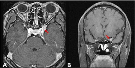 톨로사 헌트 증후군 (Tolosa Hunt Syndrome) : 네이버 블로그