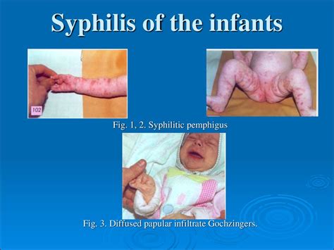 Tertiary, visceral syphilis, neurosyphilis - презентация онлайн