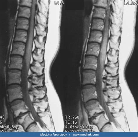 Transverse Myelitis | MedLink Neurology