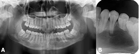 Radiographic images of central giant cell granuloma (CGCG) A)... | Download Scientific Diagram