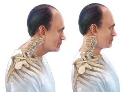 Fix Your Forward Neck Posture With These Easy Stretches | Bad neck posture, Text neck, Posture ...