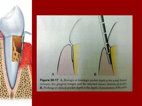 Periodontal Pockets