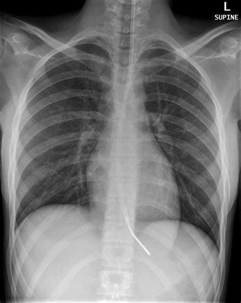 Assessing Nasogastric (NG) Tube Placement | Geeky Medics