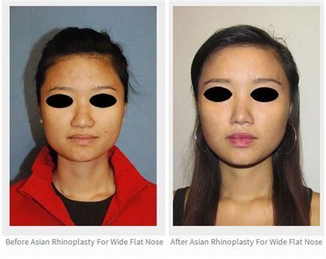 Asian Rhinoplasty for wide flat nose, bridge and nostrils | Facial plastic surgery, Rhinoplasty ...