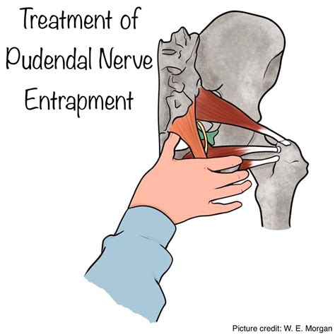 Exercises for pudendal nerve entrapment – Artofit