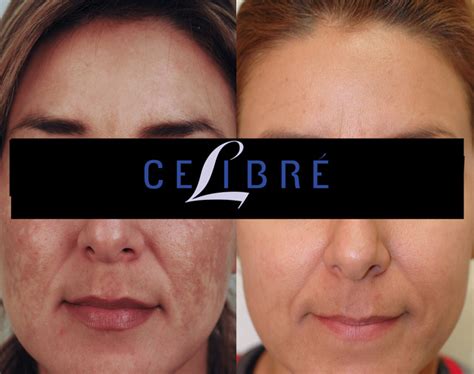 Melasma Before and After Pictures