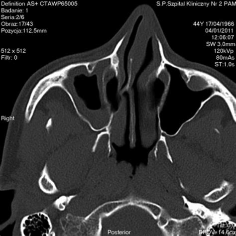 Axial CT scan – chronic maxillary sinusitis, polypus | Open-i