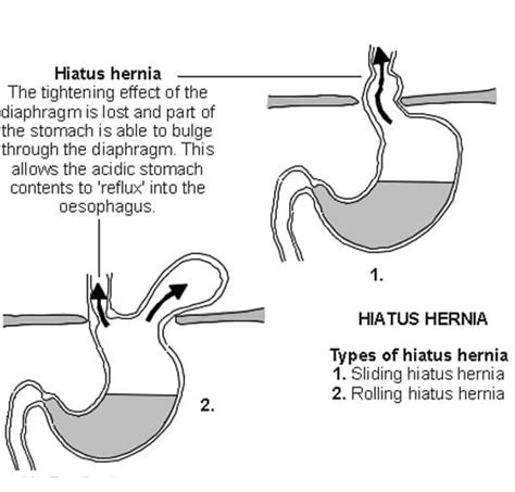 Hiatal Hernia - DSSurgery