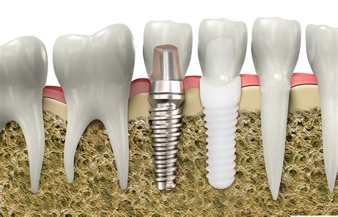 Titanium or Ceramic Implants: Does It Make a Difference Which You Choose? | Green City Dental