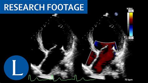 Dilated left ventricle with global hypokinesia. Libman-Sacks endocarditis: 1 of 4 - YouTube