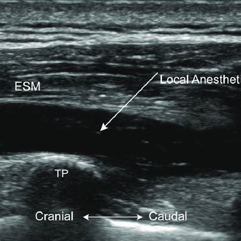 Ultrasound image taken after the erector spinae plane block (ESPB). ESM ...