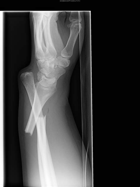 Galeazzi fracture | Image | Radiopaedia.org