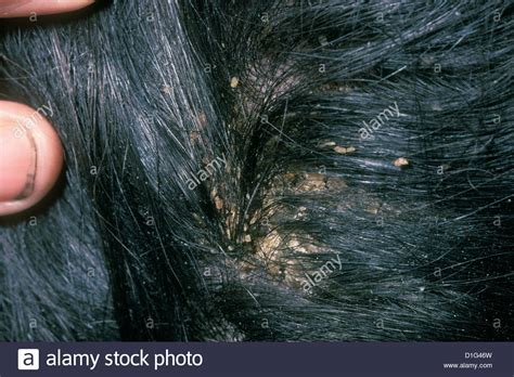 PEDICULOSIS CAPITIS - HEAD LICE INFESTATION Stock Photo, Royalty Free Image: 52600321 - Alamy