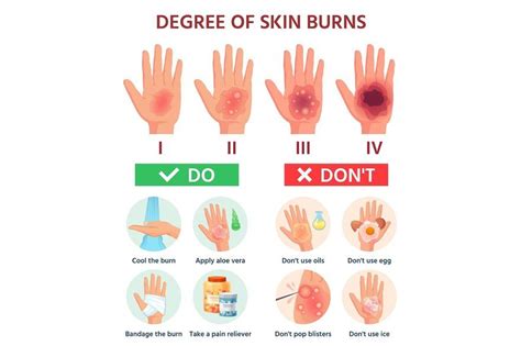 Burn First Aid, First Aid For Burns, Safety And First Aid, Fire Safety ...