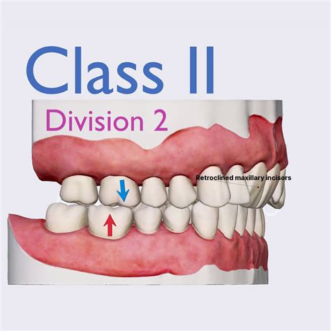 Angle's classification: Class II, Division 2 | Introduction to dental occlusion | Dental Anatomy ...