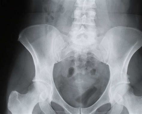 Sacroiliac Joint Injections - Personal Injury Medical Experts | Lien Based Doctors | Universal Care