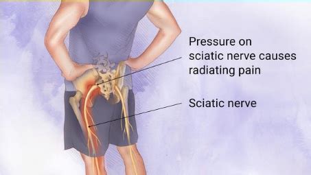 Slipped Disc | Delhi Pain Management Centre