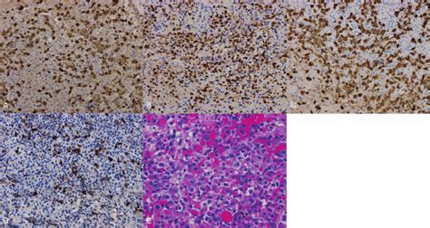 Pathological immunohistochemistry. A, Lymphoma cells ALK(+); B ...