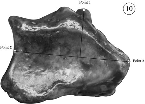 Anatomical Localization of Lister’s Tubercle and its Clinical and Surgical Importance ~ Fulltext