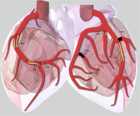 Coronary Artery: Vessel Coronary Artery Disease