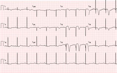 Wellens’ Sign (Wellens’ Syndrome) - JETem