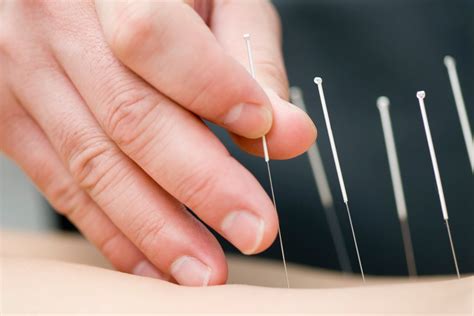 Acupuncture for Sciatica: Everything You Need to Know | Dorsal