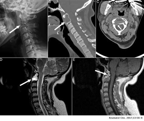 Giant Cell Tumor of the Spine: A Rare Cause of Cervical Pain ...