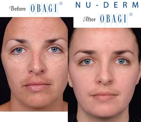 Obagi® Before and After Pictures – Micki Ly M.D. Maui Dermatologist