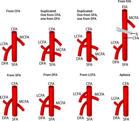 The origin of the medial circumflex femoral artery: a meta-analysis and proposal of a new ...