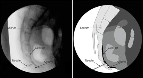 Ganglion Impar Block | Anesthesia Key