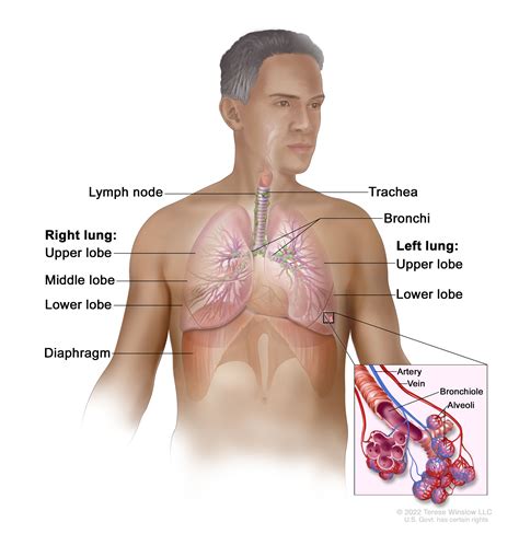 Lung Cancer Screening - NCI