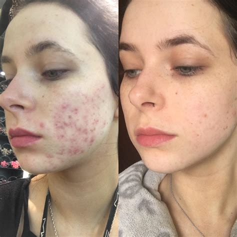 [B&A] Wanted to share my results... 4 months after starting accutane! : r/SkincareAddiction