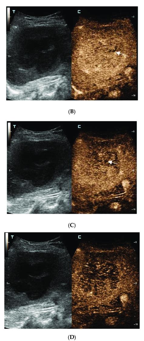 The contrast-enhanced ultrasound images of the hepatic lesion. A... | Download Scientific Diagram