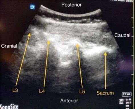 SciELO - Brasil - Dual epidural catheters for labor analgesia in a spinal cord injury patient: a ...