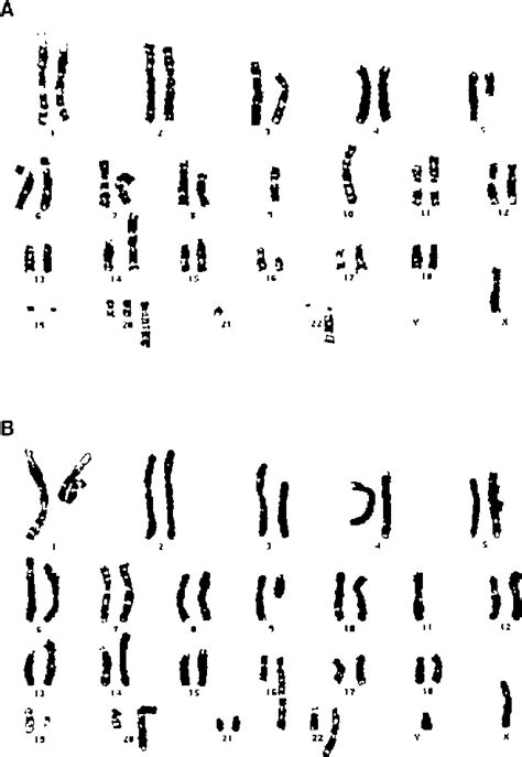 CHROMOSOME 9p DELETION SYNDROME | Semantic Scholar